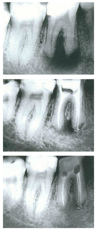 Лечение кисты зуба Бийск